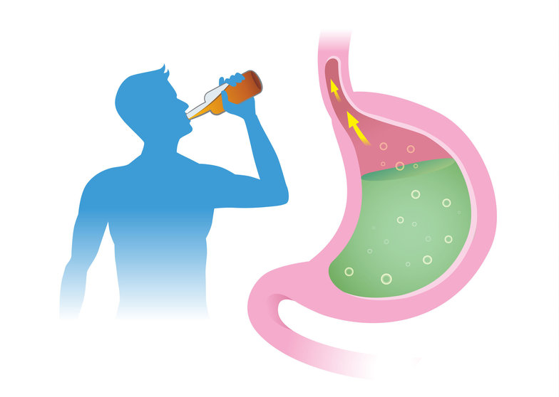 93163474 - people have acid reflex in stomach from drink alcohol. illustration about gastroesophageal reflux disease.