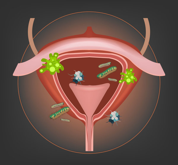 37665396 - human bladder with bacteria and germs. vector illustration