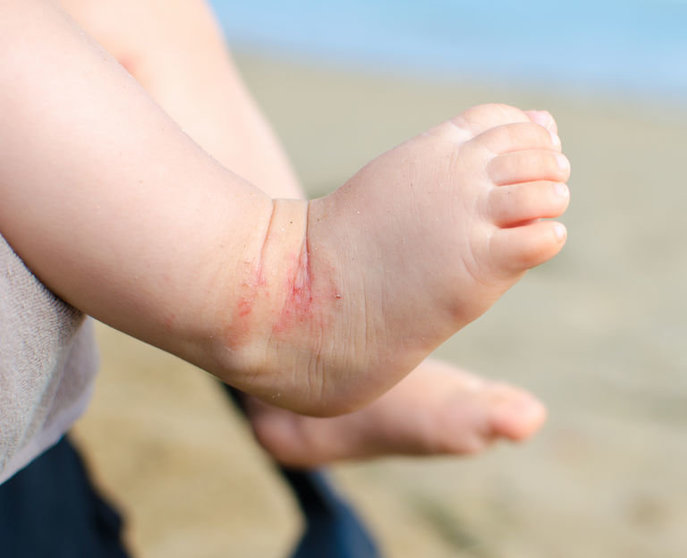 65255524 - atopic dermatitis newborn feet eczema