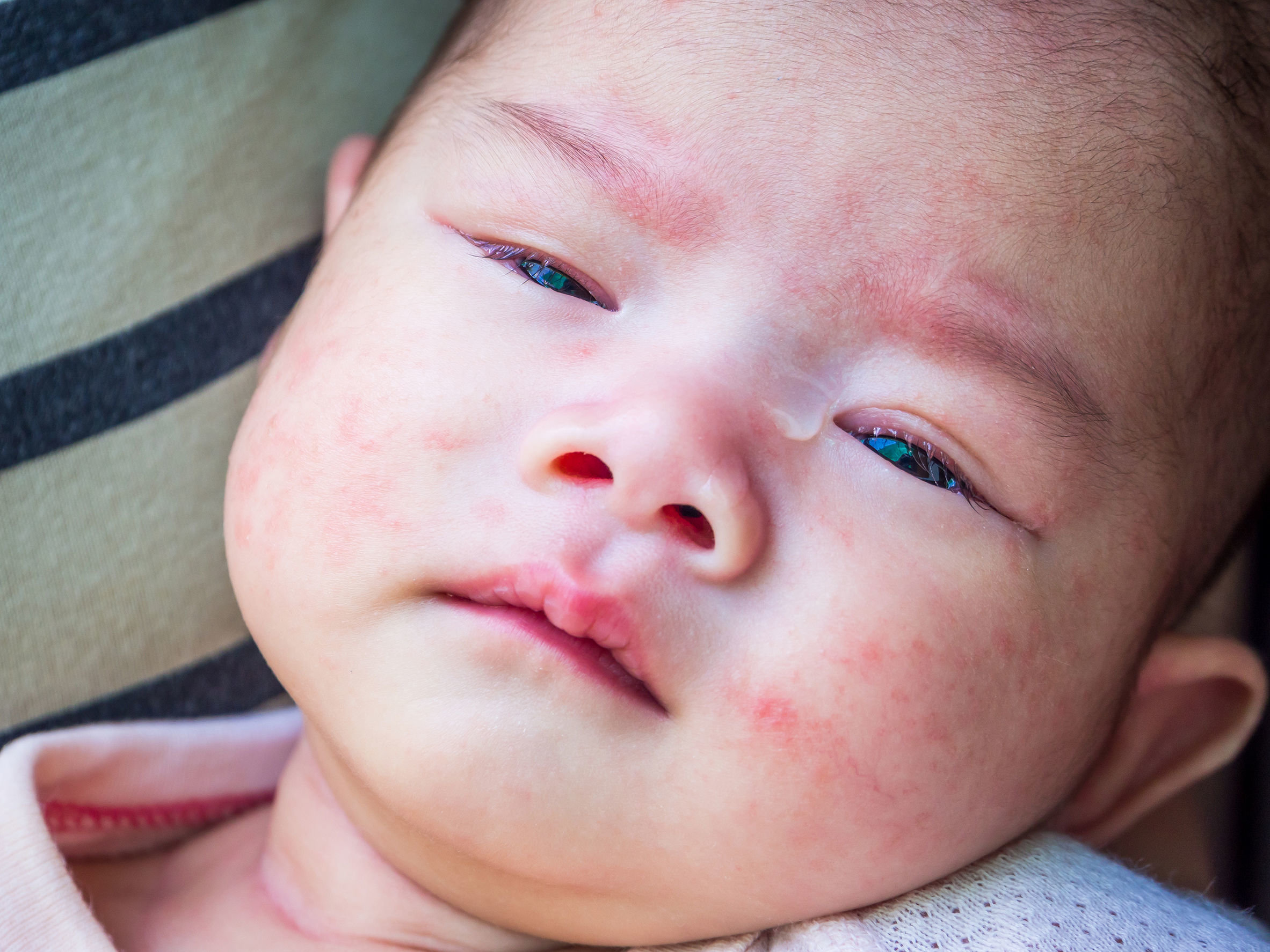 dermatitis en niños se debe prevenir desde el nacimiento - Salud -